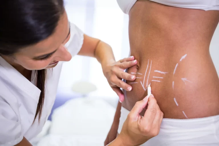 surgeon drawing lines womans abdomen liposuction cellulite removal ()